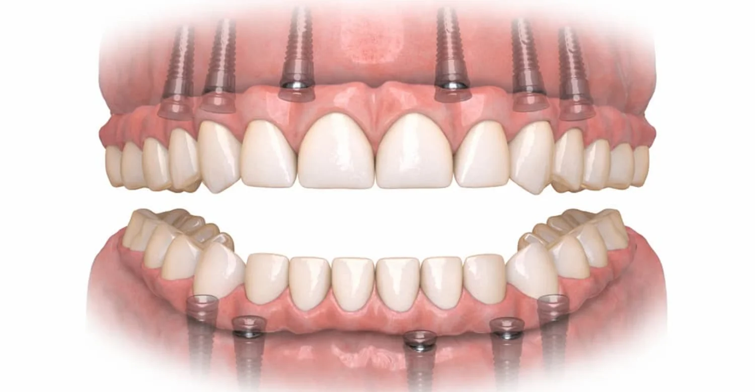Implant Supported Full Arch Prostheses 2